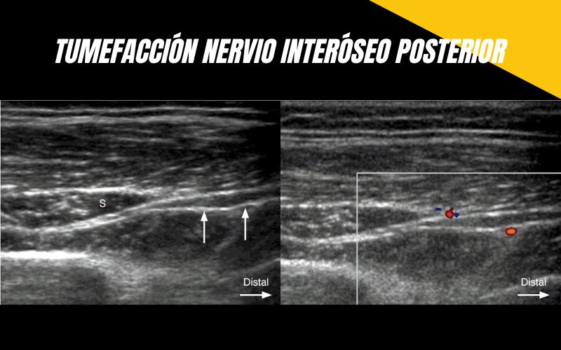 3. Nervio Interoeo Posterior Ecografia Tempo Formacion.png